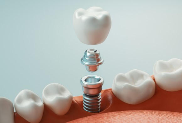 mexico for dental implants