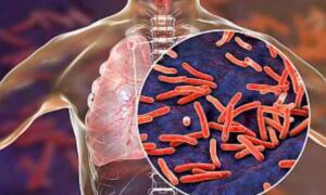 How Infectious is Tuberculosis and How to Stay Safe