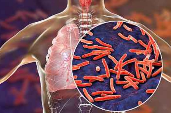 How Infectious is Tuberculosis and How to Stay Safe