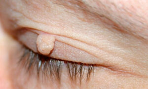 Skin Tag On Eyelid Removal At Home