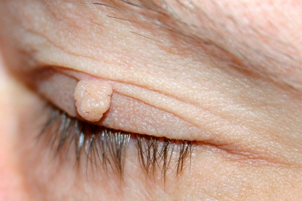 Skin Tag On Eyelid Removal At Home