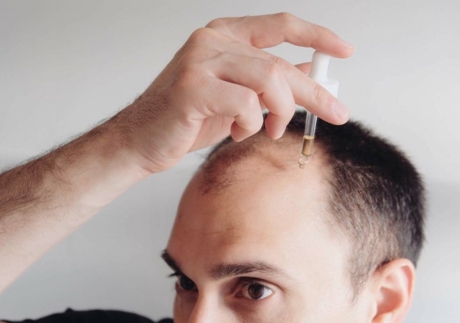 Using Minoxidil For Receding Hairline: What To Know?
